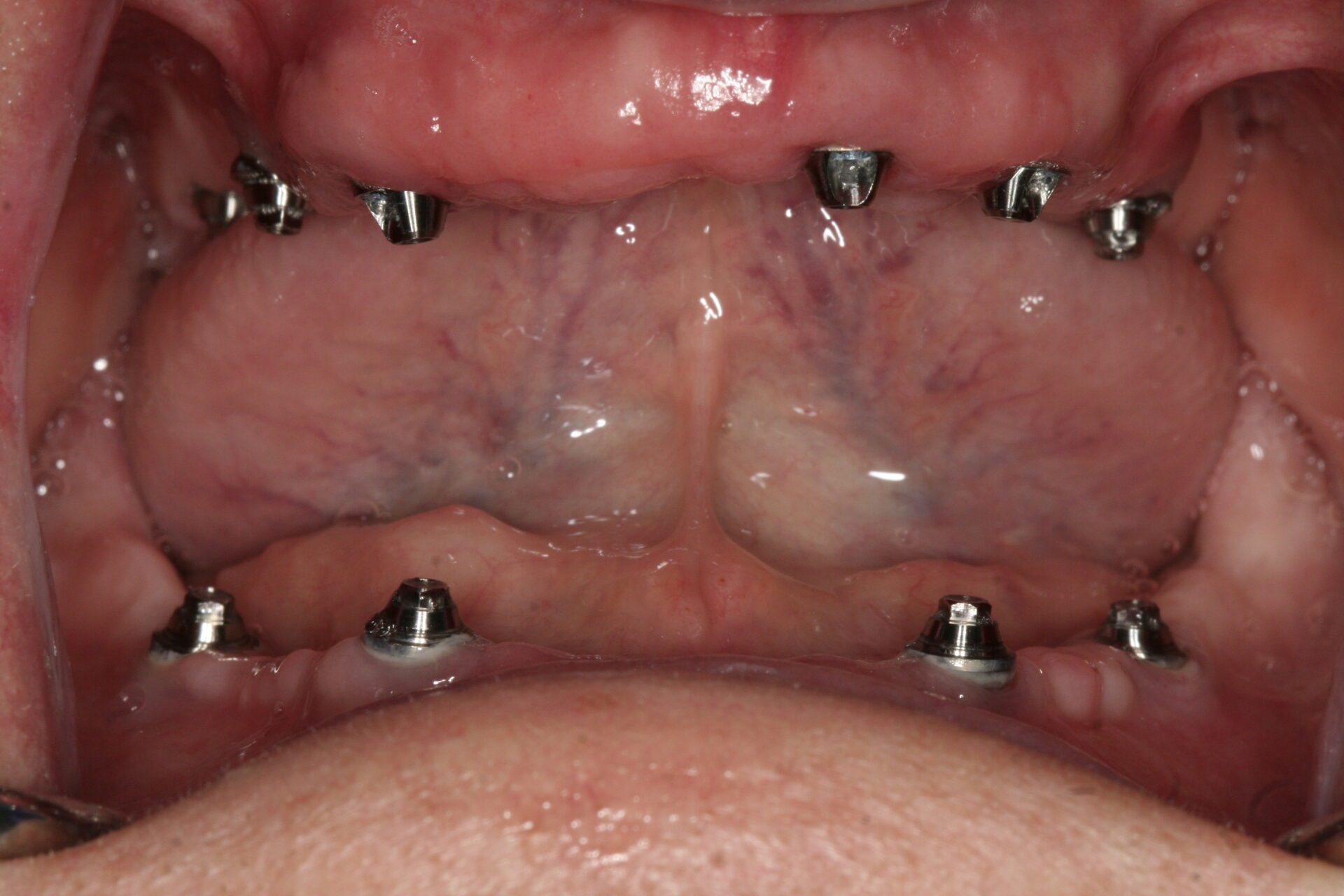 Oral Rehabilitation Case 3