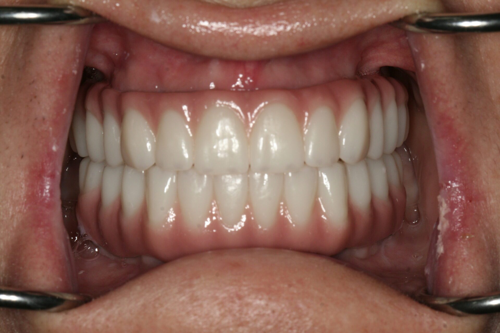 Oral Rehabilitation Case 3