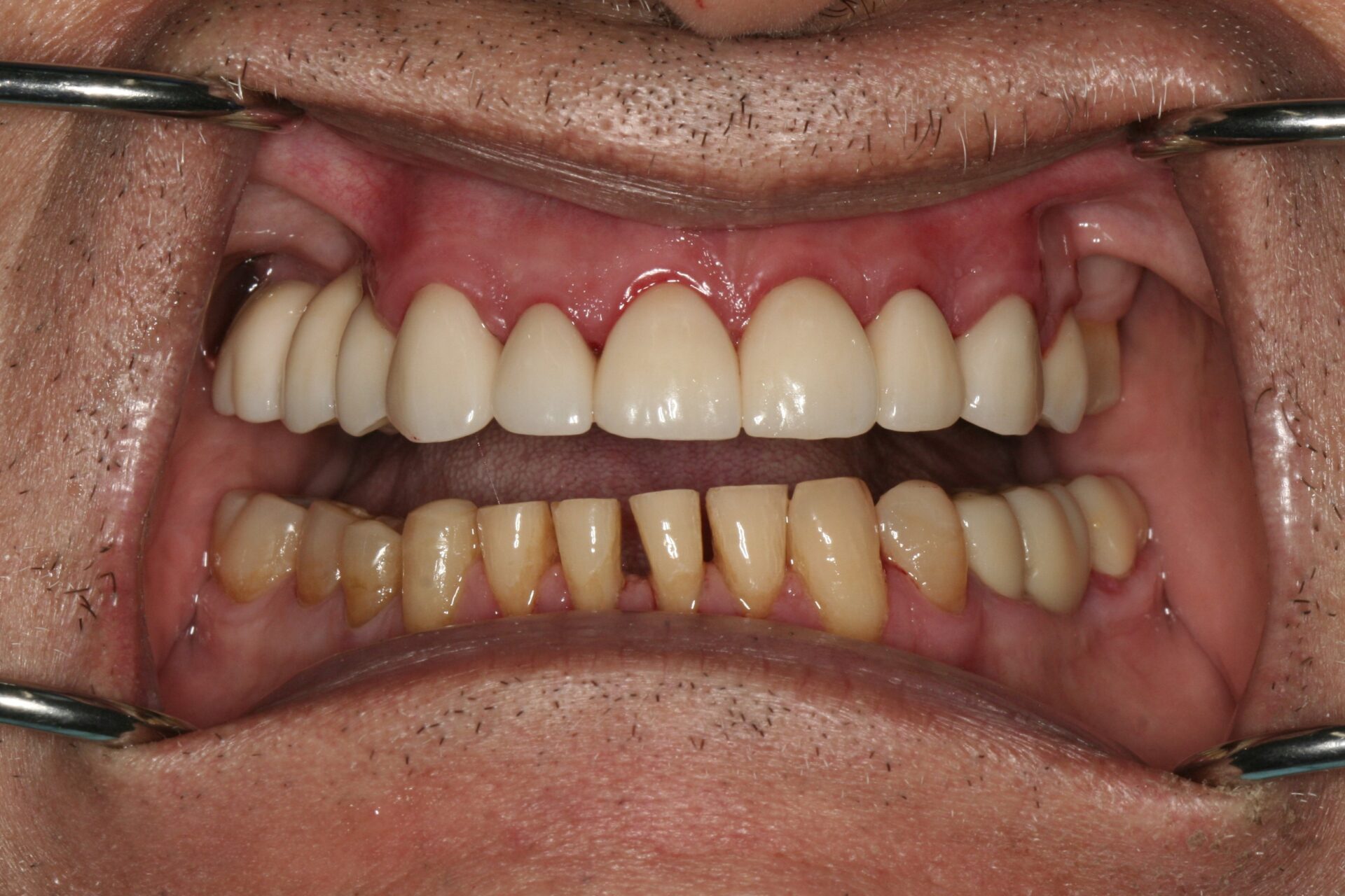 Oral Rehabilitation Case 3